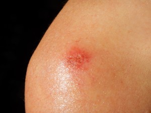 Impetigo on shoulder